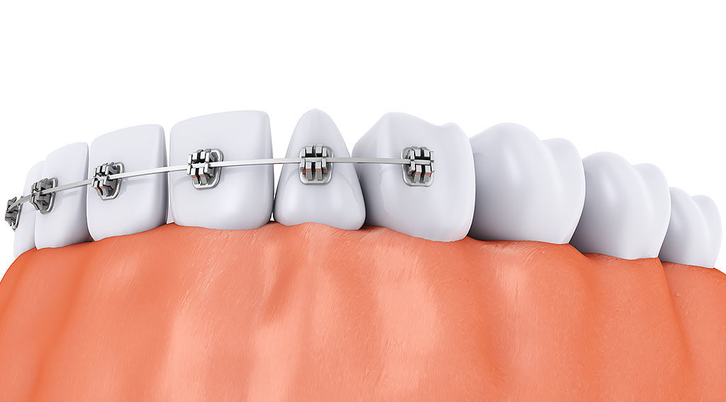 矯正装置の種類